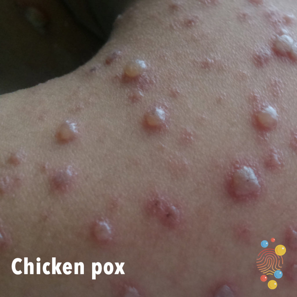 OD7-chicken-pox-1024x1024.jpg